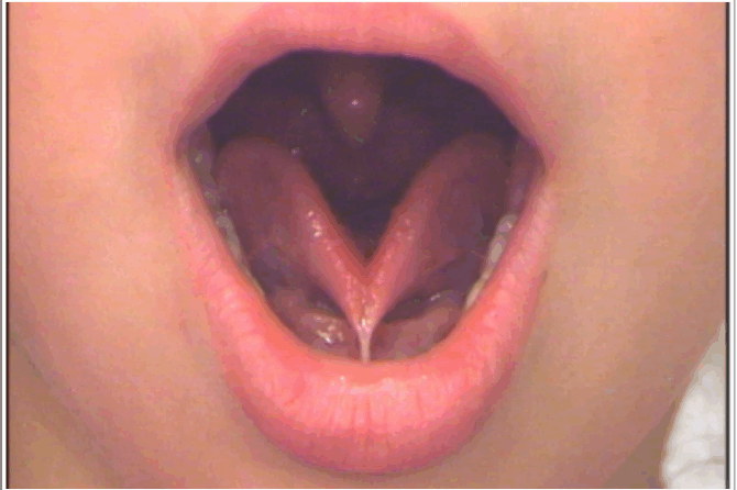 Frenulo linguale corto nel neonato: cos’è, come riconoscerlo e quando intervenire